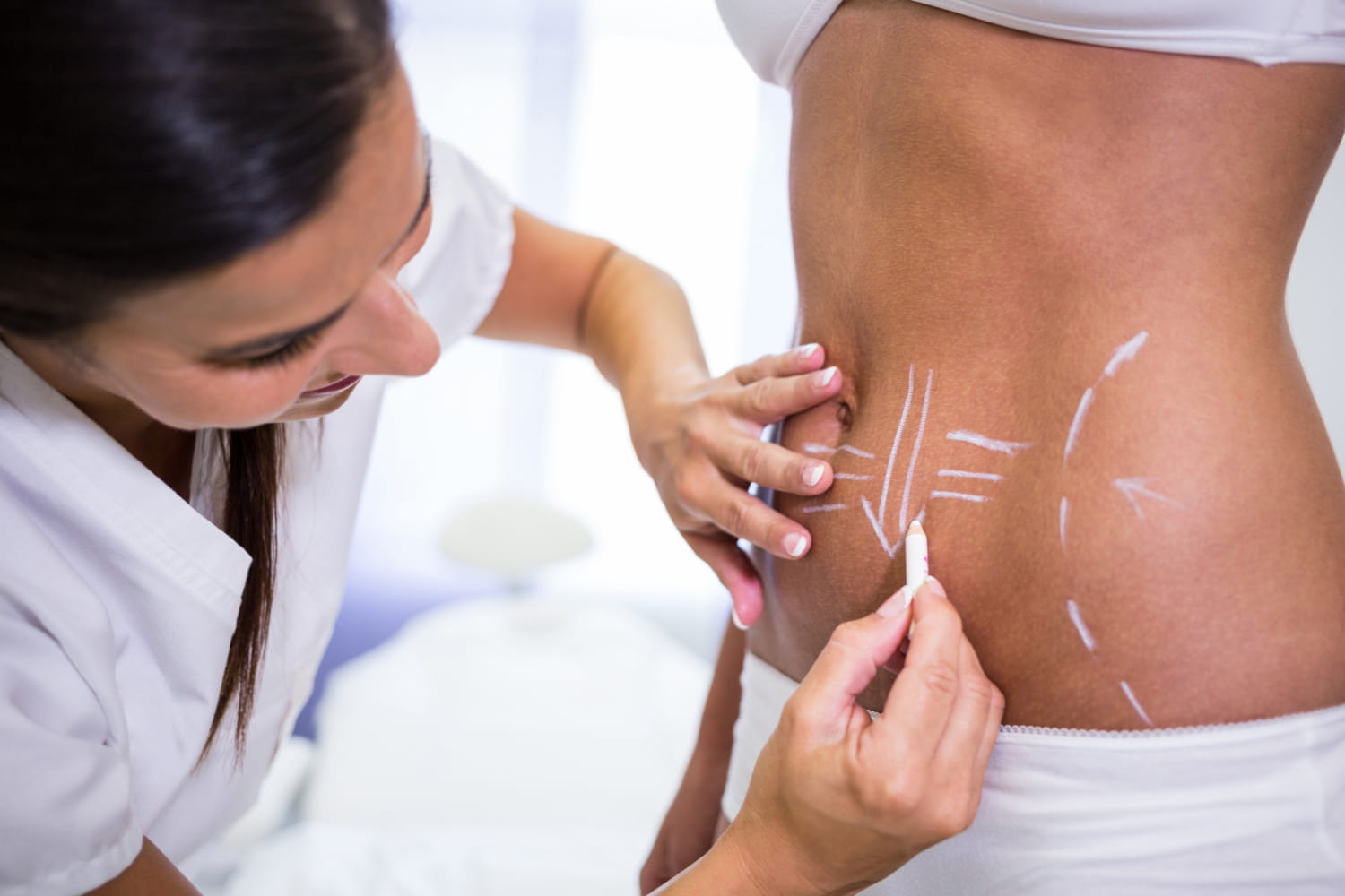Cirurgião desenhando linhas no abdômen da mulher para hidrolipoaspiração