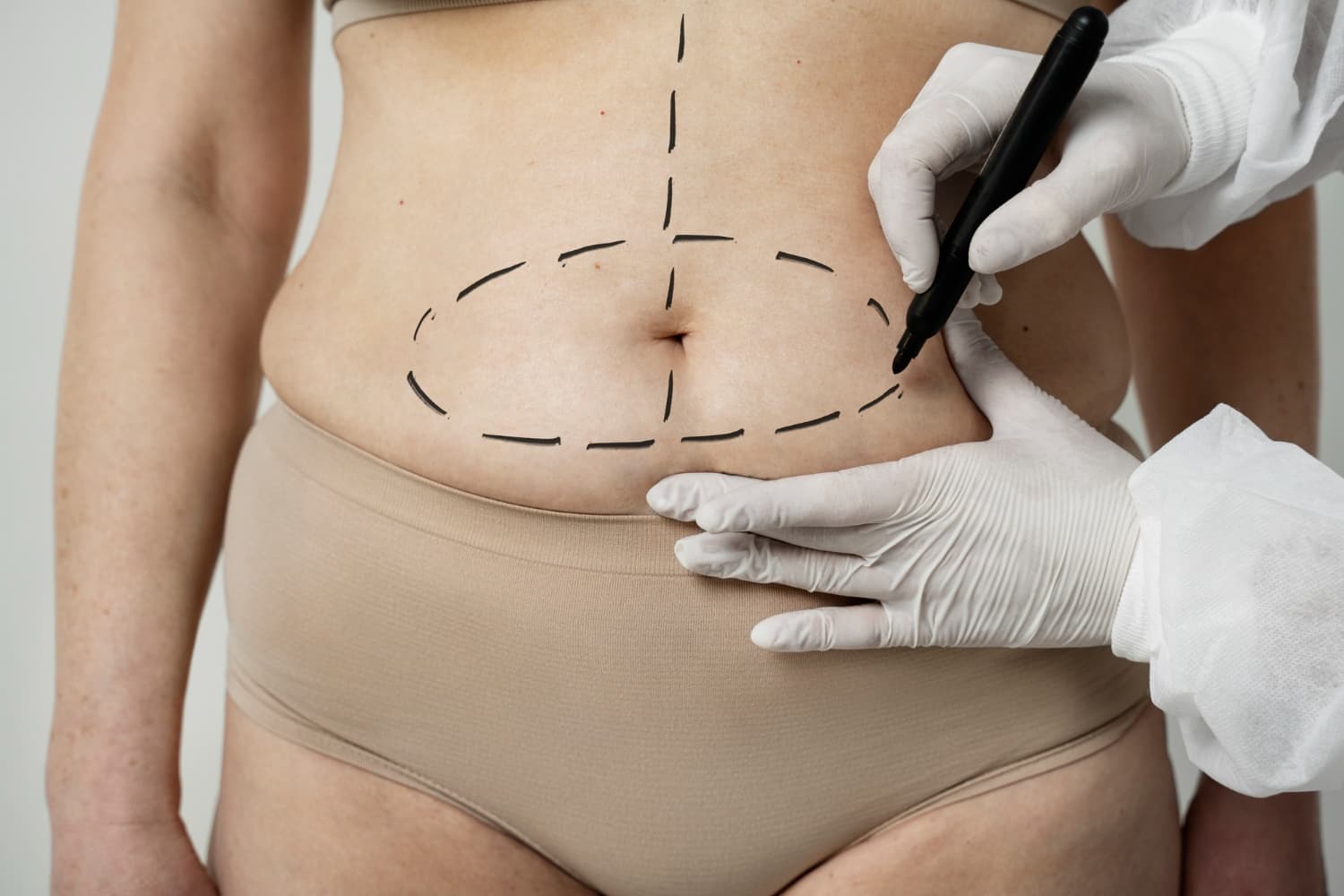 Lipoaspiração com segurança, melhora do contorno corporal e resultados naturais. Entenda como funciona e para quem é indicada.