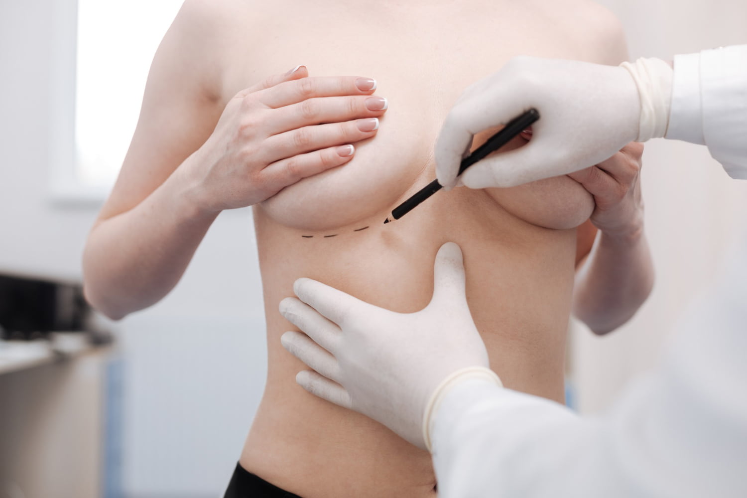 Médico marcando linhas nos seios de paciente para a mastopexia