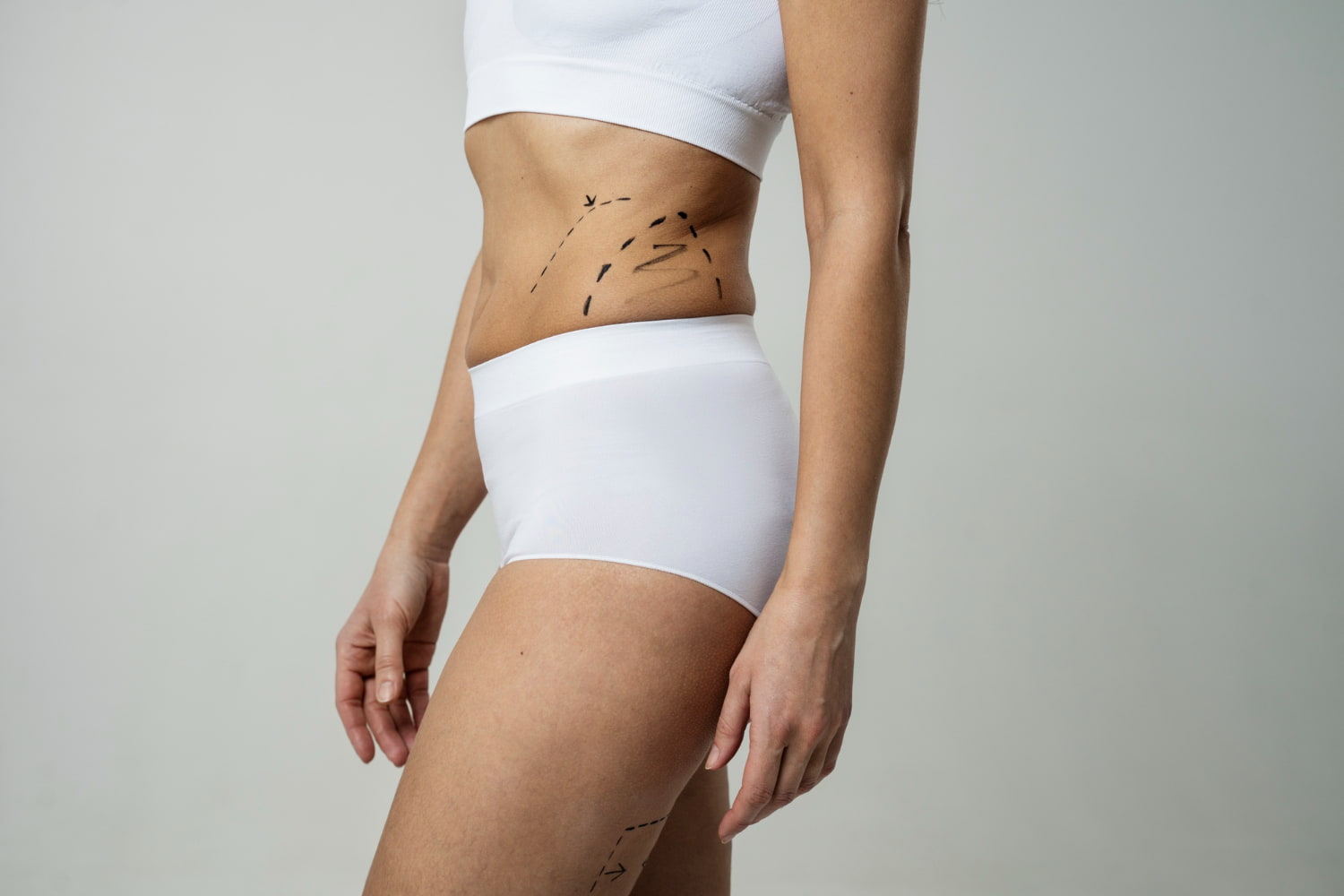Silhueta de corpo feminino com marcações no tórax para hidrolipo HD