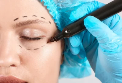 Blefaroplastiablog-1920w